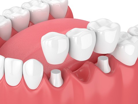 Fixed dental bridges and implants at Lauren Becker DDS, PC 