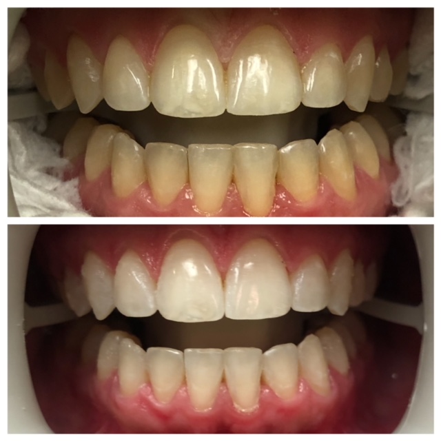 Teeth whitening treatment at Lauren Becker DDS, PC 