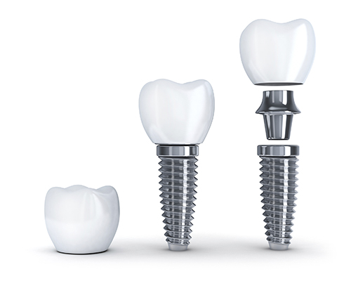 Dental Implants from Lauren Becker DDS, PC 