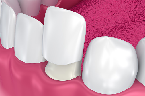 Porcelain Veneers at Lauren Becker DDS, PC 