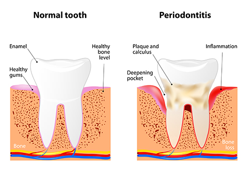 Illustration of a tooth with periodontal disease, in need of scaling and root planing, at dentist office in New York, NY.